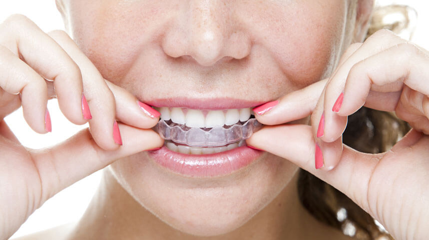 How Long You Have to Wear Invisalign and Why You Need To