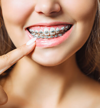 How do braces work?