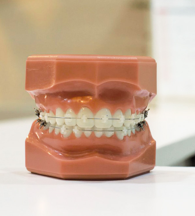 ceramic-braces02.jpg