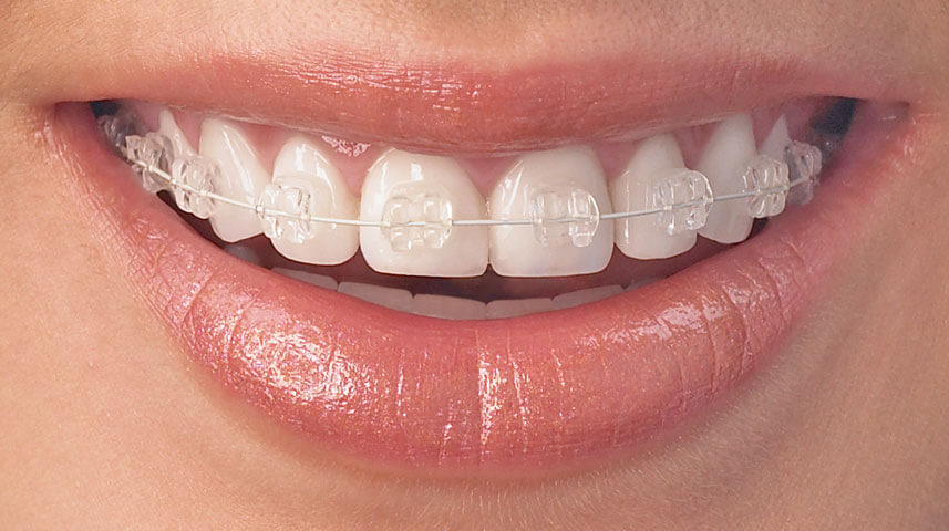 8 Must Know Care Tips When Wearing Clear Braces