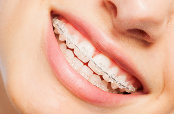 8 Must Know Care Tips When Wearing Clear Braces - The Bachmayer
